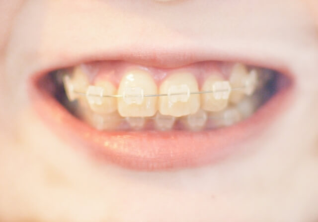 八重歯がある人とない人の違いとは 八重歯が可愛いのは日本だけの事実 ナレッジ 雑学